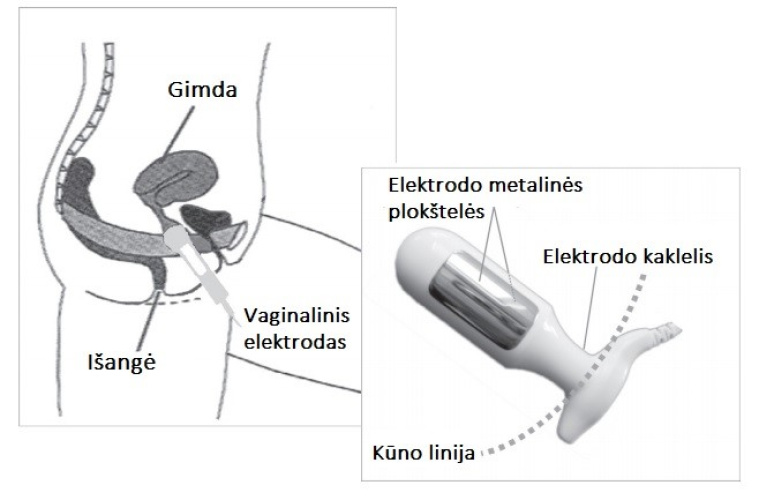 Dubens dugno raumenų stimuliacijos aparatas NeuroTrac CONTINENCE